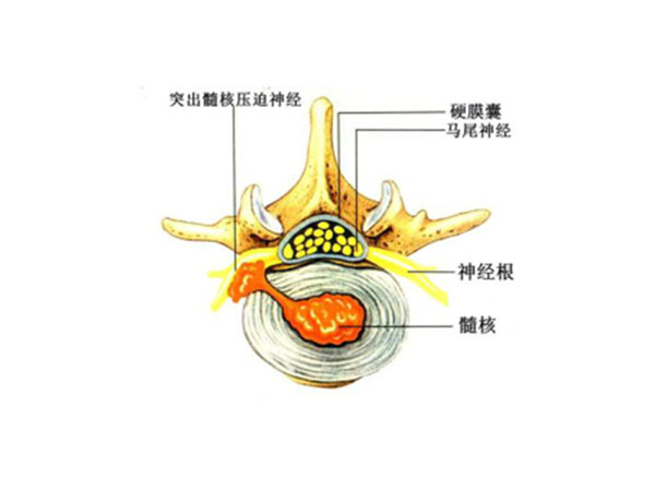 腰椎间盘突出症产生的原因？