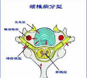 看看你是哪种类型颈椎病