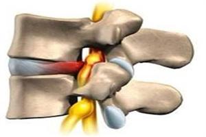 腰椎间盘突出症