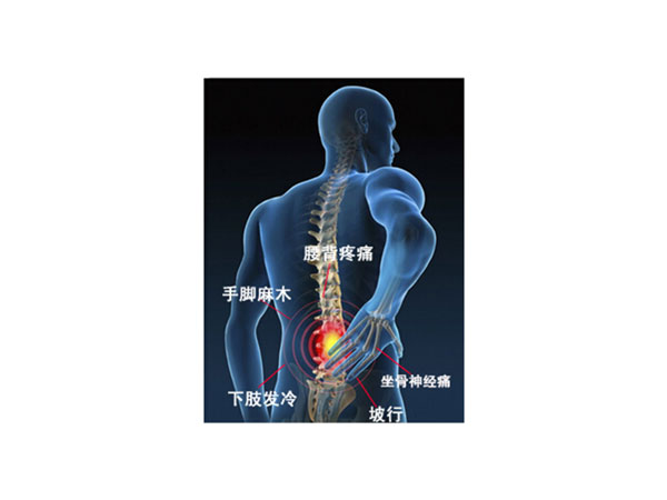 腰椎间盘突出症概述