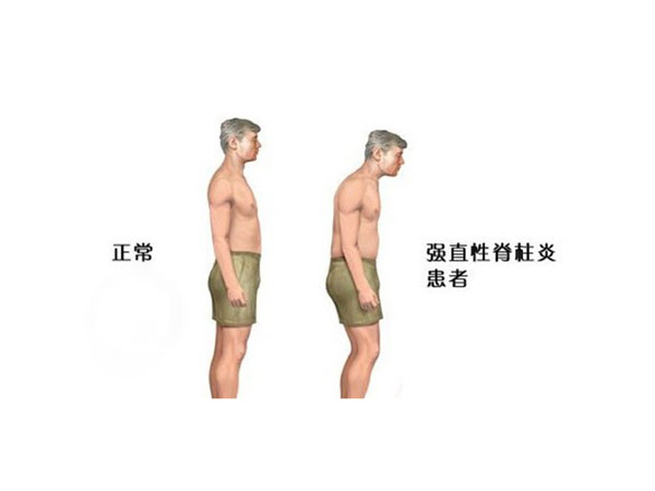 强直性脊柱炎概述